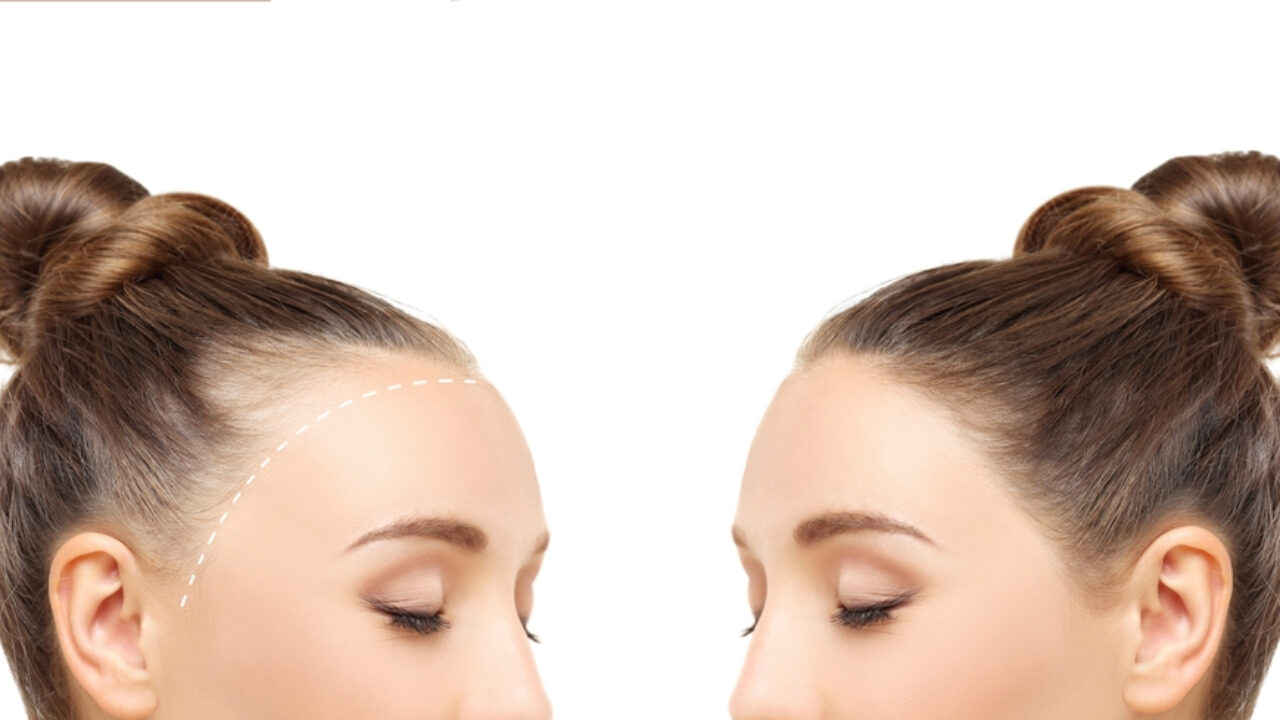 hairloss_mydreamsalon